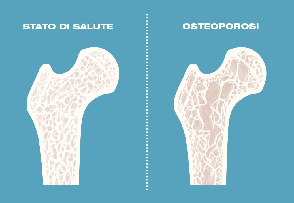 Schema ossa con osteoporosi
